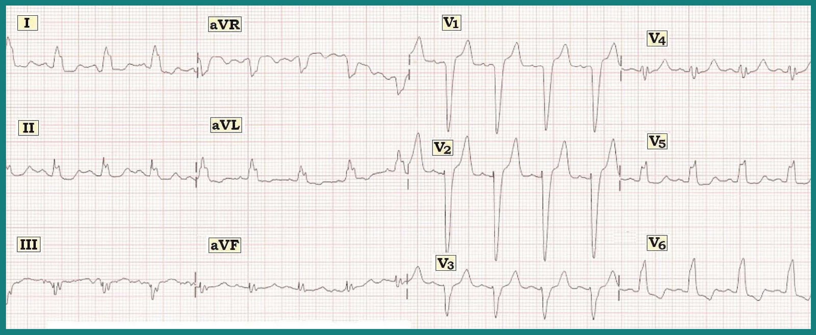 Ecg Pdf Files